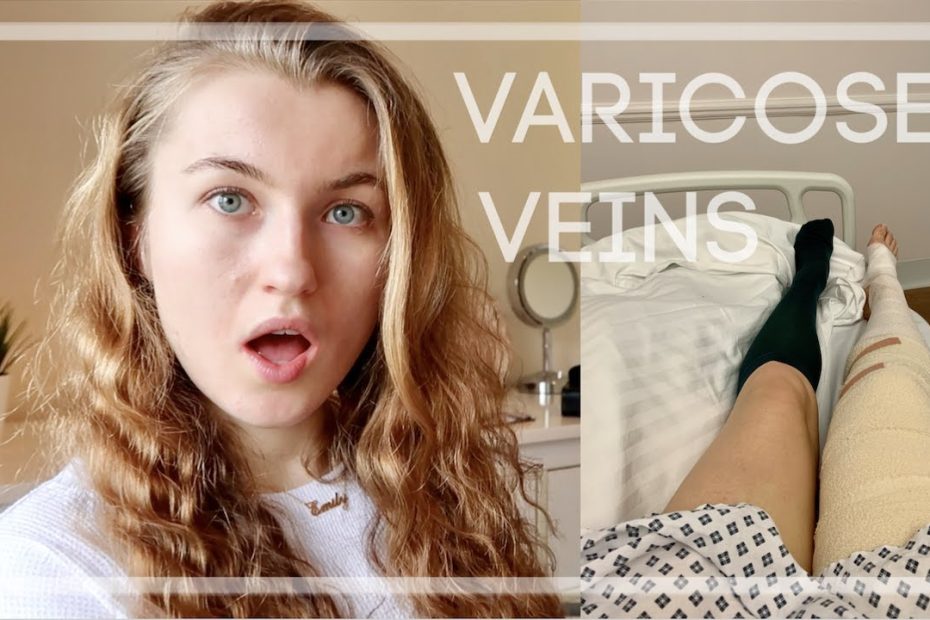 VARICOSE VEIN SURGERY AT 24 | MY EXPERIENCE & ADVICE