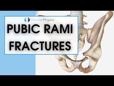 Pubic Rami Fractures | What are they? How do you treat them?